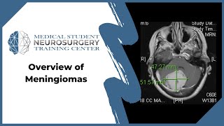 Overview of Meningiomas [upl. by Aek]