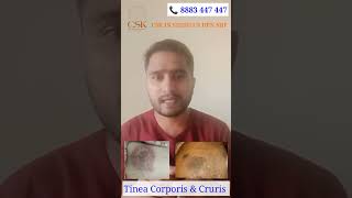 Tinea Corporis amp Cruris  Fungal infection [upl. by Haela]