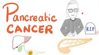 Pancreatic Cancer  Risk Factors Symptoms Signs Diagnosis Management [upl. by Ttennaej]