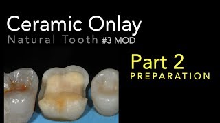 Lithium Disilicate Ceramics Part 2 Ceramic Onlay Preparation [upl. by Salohcin]