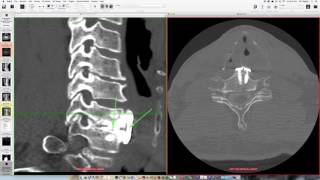 Cervical microforamintomy after ACDF [upl. by Dhiren165]