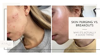 Skin Purging vs Breakouts Whats the Difference [upl. by Adnesor]