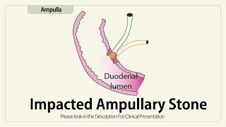 Impacted Ampullary Stone [upl. by Nolana169]