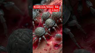 Scabies treatment scabies shortsdiljitdosanjh ytshortsindia [upl. by Hermann]