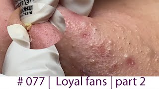 Acne Treatment Huong Da Nang 077  Loyal fans  part 2 [upl. by Hetty908]