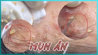 Big Cystic Acne Blackheads Extraction Blackheads amp Milia Whiteheads Removal Pimple Popping [upl. by Aisetal]