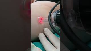 LASER SMAGLIATURE DEEP FX [upl. by Desai894]