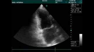 Apical hypokinesis echocardiography doppler ultrasound [upl. by Maximo]