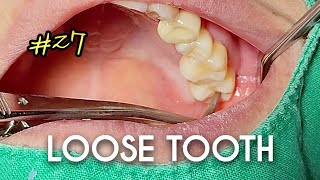 ASMR Loose Tooth Extraction [upl. by Wolcott]