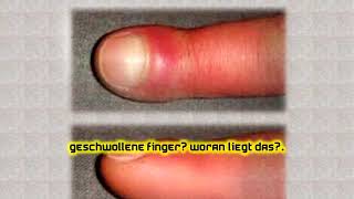 Geschwollene Finger Woran liegt das [upl. by Haimrej]