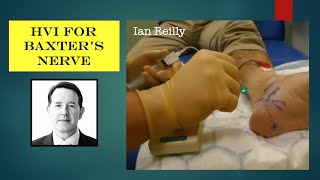 Video  Baxters nerve entrapment high volume injection hydrodissection using nerve stimulator [upl. by Bohlin]