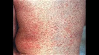 The causes and treatment of Roseola [upl. by Dibrin]