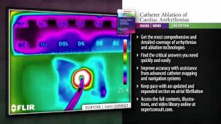 Catheter Ablation of Cardiac Arrhythmias 2nd Edition [upl. by Shepherd]