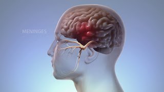 What Happens In Your Body During Migraine  WebMD [upl. by Annoya760]