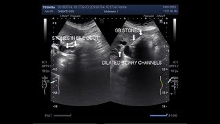 Ultrasound Video showing cholelithiasis associated with Choledocholelithiasis [upl. by Yllut]