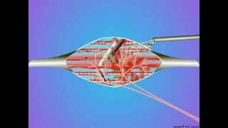 09Trigger Point Dry Needling [upl. by Christophe]