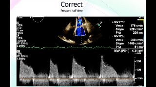 Mitral Stenosis Echocardiographic Assessment [upl. by Ulland]