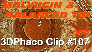 3D Phaco Clip 107  Malyugin and Balanced Tip VR Headset Version [upl. by Nilra]