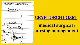 cryptorchidismmedical surgical topic nursing course [upl. by Ahsonek]