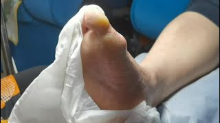 Pedicure Tutorial  Dead skin removal and Cracked heels treatment Callus removal from feet [upl. by Gladi]