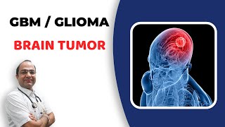 Glioma Brain Tumour Treatment  GlioblastomaGBM Cancer  दिमाग का कैंसर  Best Homeopathic Doctor [upl. by Gwenny]