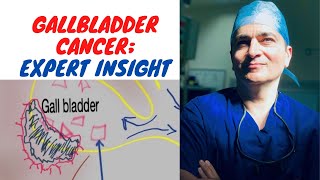 Gallbladder Cancer Symptoms Diagnosis Treatment Expert Insight with simple line drawings [upl. by Fitzsimmons]