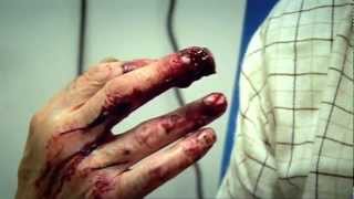 Circular Saw Accident Part 1  Bizarre ER [upl. by Acyssej293]