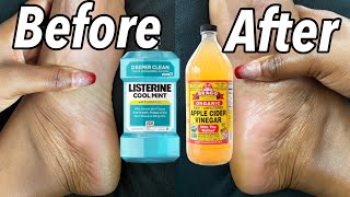 LISTERINE AND VINEGAR FOOT SOAK DOES IT REALLY WORK  SHOCKING RESULTS [upl. by Kendall]