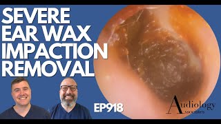 SEVERE EAR WAX IMPACTION REMOVAL  EP918 [upl. by Mikaela]