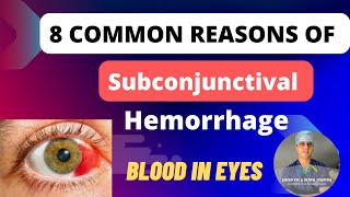 Blood in eyes  Subconjunctival Hemorrhage 8 Reasons and Treatment [upl. by Isabella831]