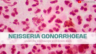 Neisseria Gonorrhoeae under the microscope with Gram stain [upl. by Vick]