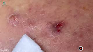 Big Cystic Acne Blackheads Extraction Blackheads amp Milia Whiteheads Removal Pimple Popping [upl. by Reel]