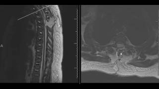 Spinal arachnoid cystmeningeal cyst [upl. by Aubarta]