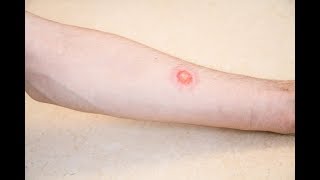 Is it ringworm Signs and symptoms [upl. by Norehs]