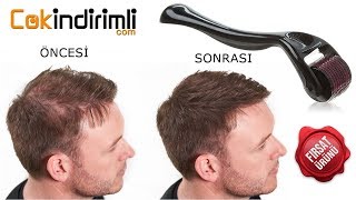 Derma Roller İle Saç Çıkarma ve Saç Dolgunlaştırma [upl. by Aehcim]