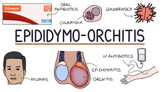 Understanding Epididymoorchitis [upl. by Anirrak]