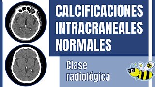 Calcificaciones de plexos coroideos calcificación de glándula pineal [upl. by Essilem669]