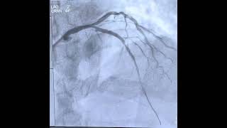 Case 12 Angioplasty of LAD instent restenosisISR with DEB [upl. by Hedvah482]