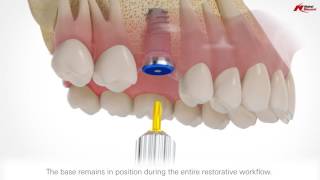 On1 restorative concept  Nobel Biocare [upl. by Haslam]