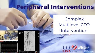 Complex Multilevel CTO Intervention [upl. by Nimrak]