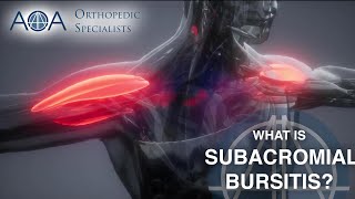 AOA Orthopedic Specialists  Subacromial Bursitis [upl. by Irah960]