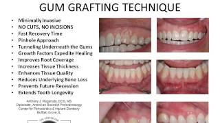 quotAlloderm Reverse Tunnelingquot Patient Handout [upl. by Occir]