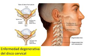 Enfermedad degenerativa del disco cervical [upl. by Adella]