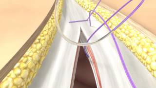 Abdominal Wall Closure BBraun [upl. by Nav348]