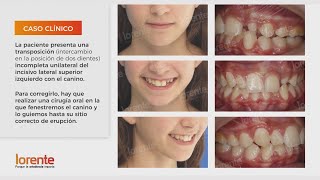 Transposición incompleta unilateral  Caso Clínicos Lorente Ortodoncia ortodoncia orthodontist [upl. by Rachaba708]