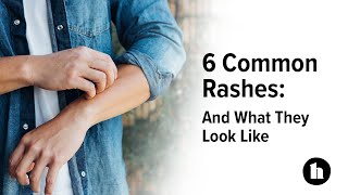 6 Common Rashes And What They Look Like  Healthline [upl. by Appilihp]