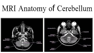 MRI Anatomy of cerebellum [upl. by Boys]