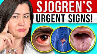 10 Signs of Sjogrens Syndrome  a very complex autoimmune disease [upl. by Lamrert]