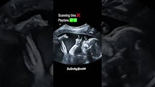 Ultrasound scan pregnancy [upl. by Oskar]