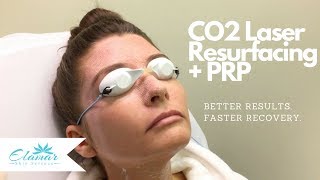 CO2 Laser Skin Resurfacing  PRP  Better Results and Faster Recovery [upl. by Abdella560]